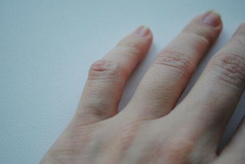 An arthritic lump appeared on his little finger. 