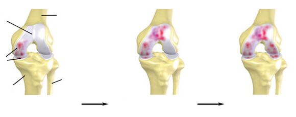 Degree Arthrosis knee joint