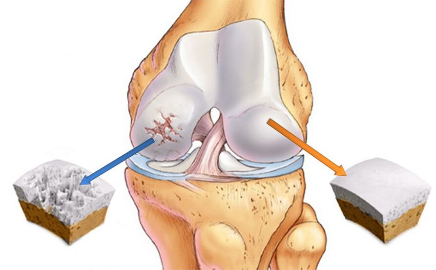 Knee wrist arthrosis