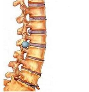 How is the osteochondrose of the cervical region developed