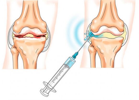 intraarticular injections for osteoarthritis of the knee