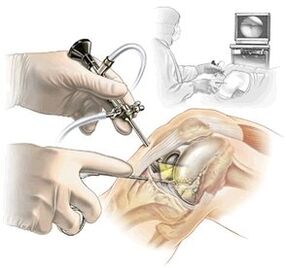 Clarification of diagnosis of arthrosis